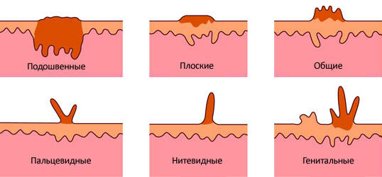 Папілома? Лікарі розкажуть, що робити! 1/1