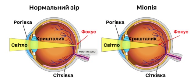 Лазерна корекція зору: що треба знати 1/1